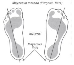 Mayer (Obrázek 16) je určen střed paty v jejím nejširším místě, ten je pak spojen s vnitřním okrajem čtvrtého prstu.