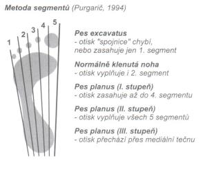 (Urban, 2000) Obrázek 16: Mayerova metoda (Riegerová, 2006) Metoda segmentů (Obrázek 17) noha je rozdělena na pět stejných částí podle přímek spojujících