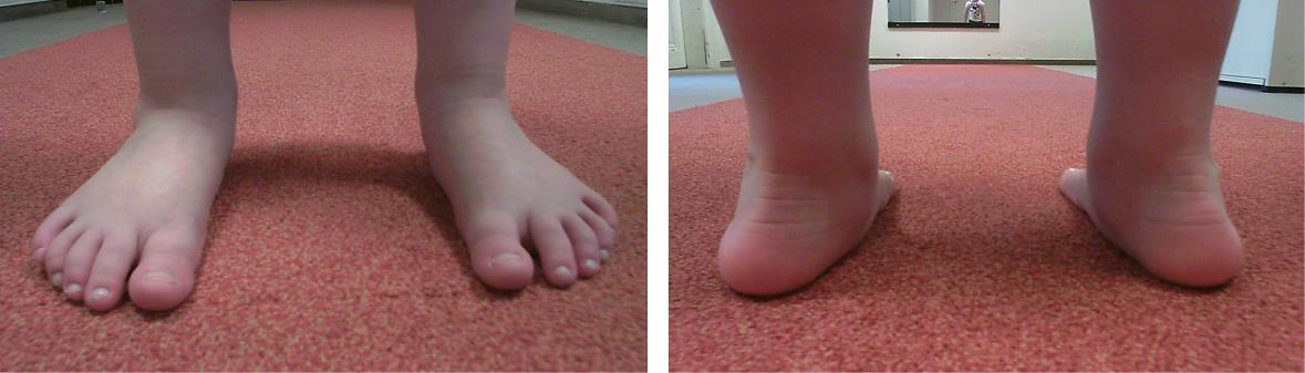 Vyšetření nohy Obrázek 45: Vyšetření nohy kazuistika 1 28 valgozita paty bilaterálně; palpačně je pravá noha bolestivá na laterální straně