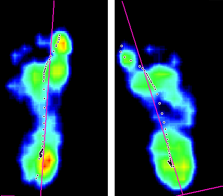 hodnocení otisku nohy metodou Chippaux-Šimiřák: levá 47,05 % (1. stupeň plochonoží), pravá 62,50 % (3. stupeň plochonoží); hodnocení otisku nohy metodou Sztriter-Godunov: levá 0,70 (2.