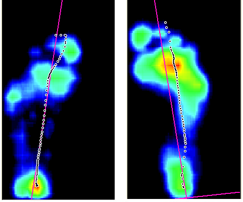 Závěr vstupního vyšetření Obrázek 54: Zatížení nohy při chůzi (vstupní vyš.) kazuistika 2 Pacientka vykazuje známky VDT, bez výraznější laxicity vazů. Pes planovalgus přítomný na obou nohách.