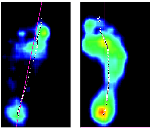 Vyšetření na Footscanu Zatížení nohy ve stoji: větší zatížení vlevo na patě, těžiště se po výrazném počátečním posunu vychylovalo jen minimálně; Obrázek 55: Zatížení nohy ve stoji (výstupní vyš.