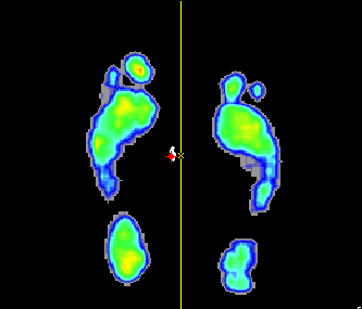 gastrocnemius oboustranně; otlaky nepřítomny; Véle test stupeň 2; Jack s toe-raising test pozitivní.