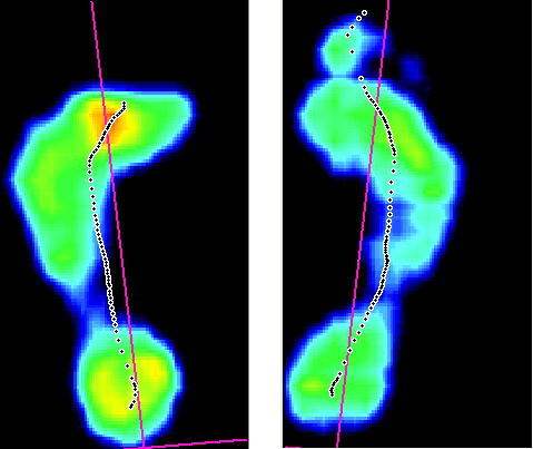 Závěr výstupního vyšetření Obrázek 62: Zatížení nohy při chůzi (výstupní vyš.) kazuistika 3 U pacientky se zlepšily subjektivní obtíže.