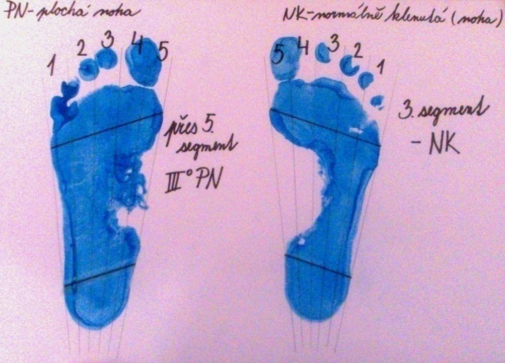 mezi os cuboideum (kost krychlová) a os cuneiformia (kosti klínové) a odpovídá nejužšímu místu na plantogramu(urban, Vařeka, Svajčíková, 2000a). 1. Pokud otisk spojnice chybí nebo zasahuje jen do 1.