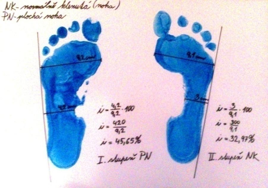 Obr. 12: Chippaux Šmiřák 13 Noha plochá 1. stupeň ploché nohy: od 45,1% do 50% se jedná o mírně plochou nohu 2. stupeň ploché nohy: od 50,1 % do 60% se jedná o středně plochou nohu 3.
