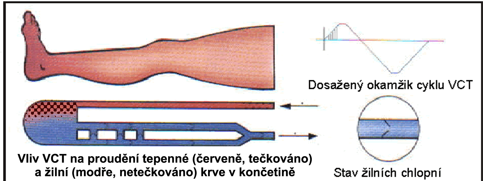 Vakuově-kompresní terapie (VCT) je založena na střídání fáze podtlaku a fáze přetlaku v aplikačním válci, ve kterém je léčená končetina hermeticky utěsněna a vystavena řízenému působení