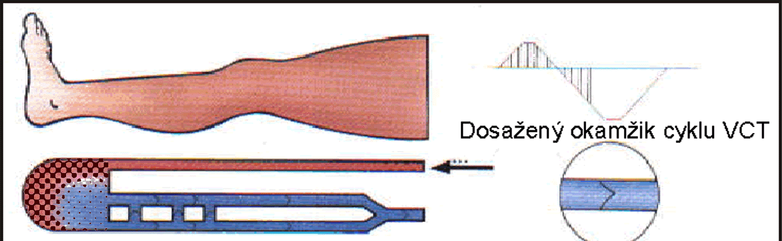 zvýšením smykového napětí při nahromadění mononukleárů) je krev přiváděna i do obliterovaných úseků periferie, kde díky indukovanému tlakovému gradientu dochází ke zlepšení látkové výměny mezi