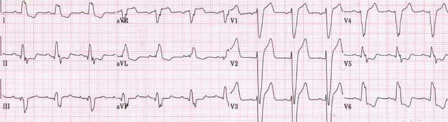 Interpretace EKG Blok levého Tawarova raménka (LBBB)