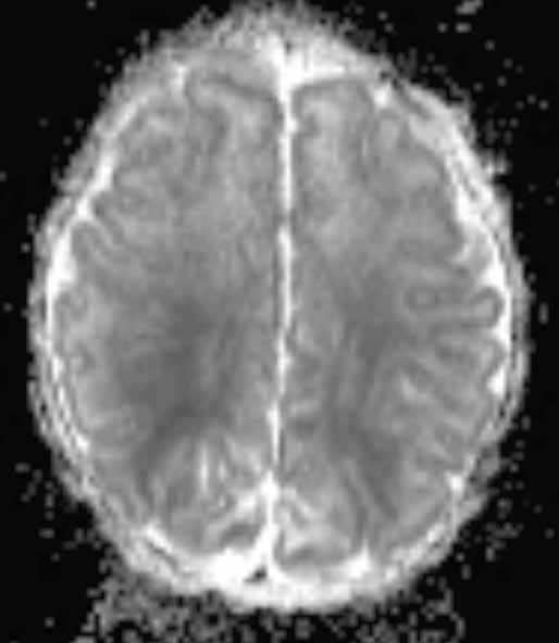 MR imaging of the term neonatal brain (girl, gestation age 38 + 5), parasagital infarction in hypoxic-ischaemic encephalopathy. A MR T1- -weighted image, axial plane.