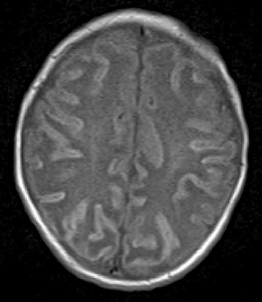 Obr. 5A Obr. 5B Obr. 5. MR vyšetření mozku donošeného novorozence (děvče, gestační věk 41 + 0), kortikální a subkortikální změny s ischemickým postižením bílé hmoty mozkové při hypoxicko-ischemické encefalopatii.