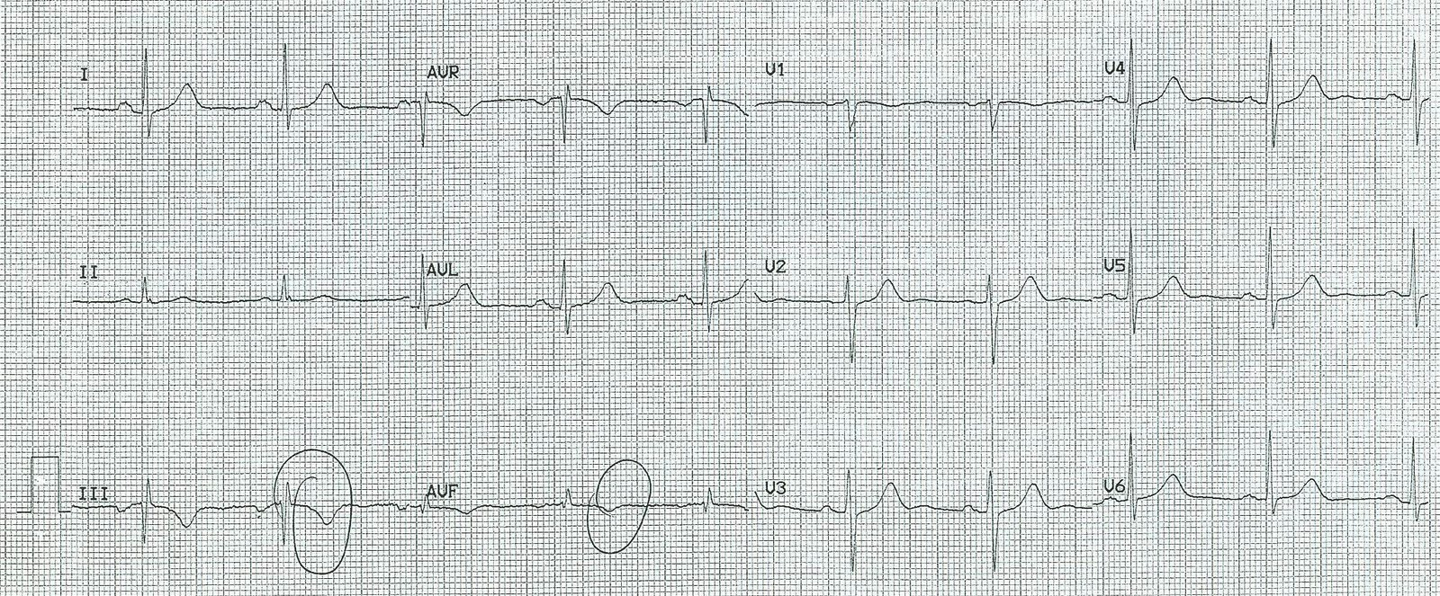 Elektronické srdce a plíce 3. Výsledky vyšetření v průběhu hospitalizace: EKG je na obrázku 1. Transtorakální echokardiografie prokázala normální nález na srdci.