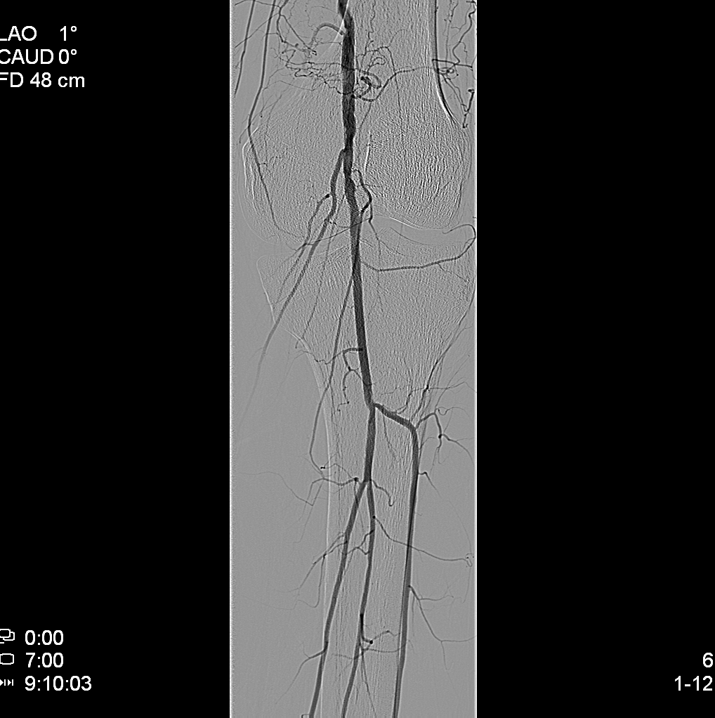 Obrázek 2. DSA s nálezem chronického uzávěru a. femoralis superficialis vlevo (nahoře). Kolaterálami se plní část femoropopliteálního přechodu, a. poplitea (dole) vykazuje okrajové nerovnosti. 5.