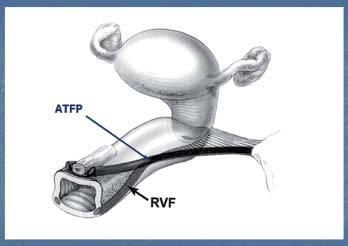 Jejich poškození způsobuje POP (3) vlastní modifikace pův. zdroje PCM horse-shoe striated muscle PUL PCM vagina lumen a longitudinal smooth muscle vascular plexus trigonal extension M.