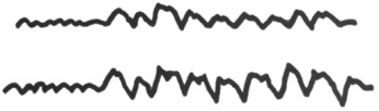 6 Hz komplexy hrot pomalá vlna (Phantom Spike and Wave) (obr. 13) jsou nízkovoltážní.