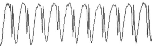 Komplexy hrot a vlna 3 Hz (3-Hz spike and wave complexes 3SWC) (obr. 21) se pravidelně opakují ve frekvenci 2,5 3,5 Hz. Výboj by měl trvat déle než 3 s a pozadí je normální.