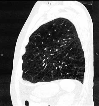 Obr. 7 Obr. 8 Obr. 9 Obr. 7. HRCT plic sagitální řez: homogenní centrilobulární plicní emfyzém Fig. 7. HRCT of the lung, sagital reconstruction: homogeneous distribution of centrilobular lung emphysema Obr.