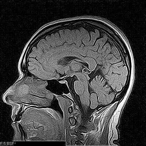 Obrázek 20: Aplikace různých úrovní ostření pomocí prostorově invariantních masek 17 (vlevo) a 18 (vpravo) Nalevo Obrázku 20 je původní MRI snímek plně zostřen pomocí prostorově invariantního