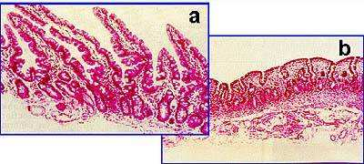 Příloha č. 2 Mikroskopický obraz změn sliznice tenkého střeva při celiakii Obr.a Negativní protilátky Normální sliznice s klky Obr.