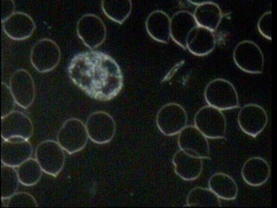 Červené krvinky v temném poli (zástinu) Obr.: http://www.lecivacesta.cz/news/vysetreni-zive-kapky-krve-v-temnem-poli-mikroskopu/ ) http://www.zdravivkrvi.cz/popis-metody http://www.irisdiagnostika.