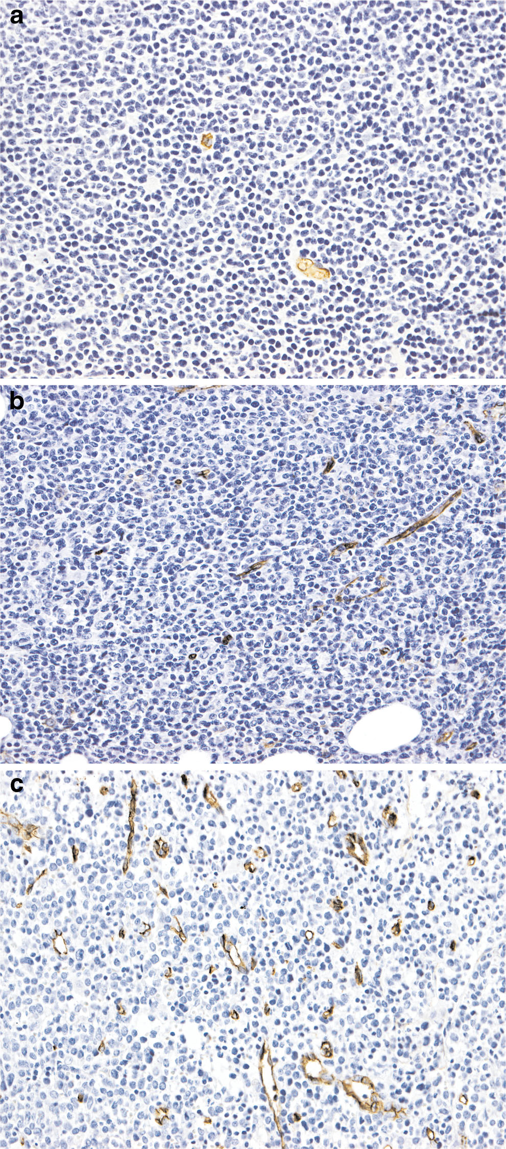 Virchows Arch (2014) 465:587 597 591 Furthermore, we assessed the prognostic value of MVD in a comparison of the non-intensive treatment group (N=111) with the intensive treatment group (N=64).