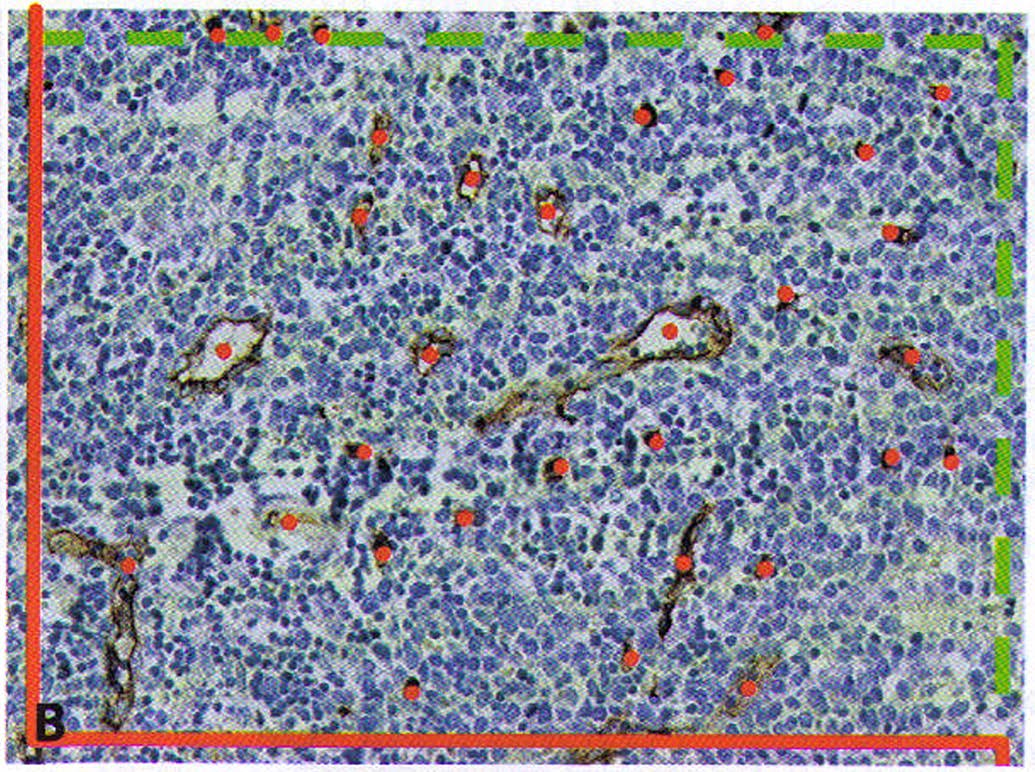 B: označení počí taných profilů mikrocév v jednom zorném poli MCL v lymfatické uzlině s využitím počítacího rámečku pro tzv.