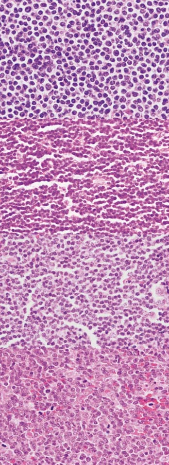 122 Hlavní téma Obrázek 1. Cytologické varianty MCL: klasická (A), malobuněčná (B), marginal zone-like (C), blastoidní (D). Vše zvětšení 400x, barvení hematoxylin-eosin A B C D sliznicí (9).