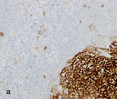 1.4.4 Prognostický vliv výsledků imunohistochemického barvení CD23 Pozitivita vyšetření s protilátkou CD23 byla zjištěna u 33 případů MCL.