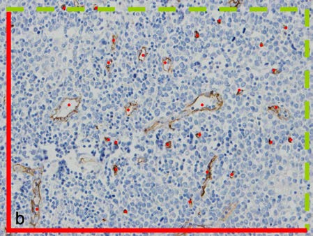 Obrázek 20 stanovení mikrovaskulární denzity pomocí metody systematického náhodného výběru zorných polí v definované oblasti; (a) vzorkování v lymfomu z plášťových buněk infiltrujícím sliznici