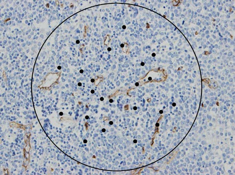 Obrázek 21 Chalkley count projekce mřížky v zorném poli lymfomu z plášťových buněk, protilátka CD34, zvětšení 200. 2.1.3 Praktické využití mikrovaskulární denzity v nádorech Možnosti praktického využití zjištěných hodnot mikrovaskulární denzity se nabízejí dvě: 1.