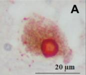 Alpha-synuclein je 14 kda protein, který je ve velké mí e exprimován v r zných ástech mozku, a který se ú astní patofyziologie n kterých neurodegenerativních onemocn ní.