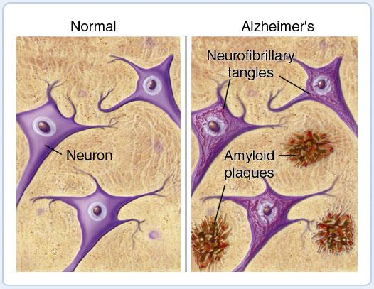 Dalším patogenetickým článkem je postiţení neurotransmiterových systémů. Nejvíce postiţeným systémem je systém acetylcholinergní, který je zásadní pro mechanismy paměti a vědomí.