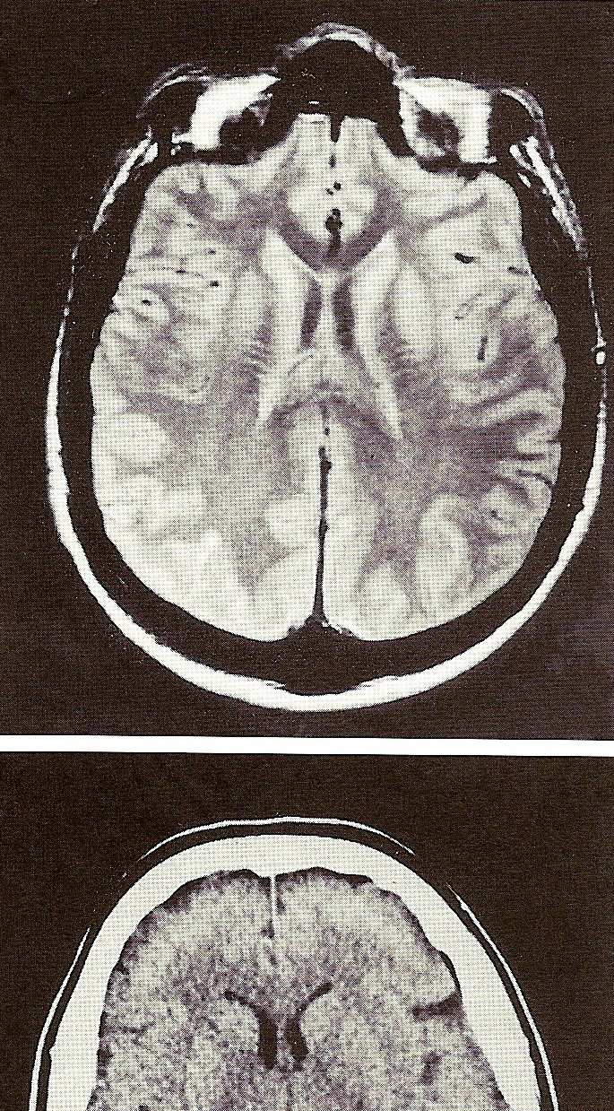 Přílohy Řezy mozkem Horizontální řezy mozkem: Obrazy získané technikou 5 thalamus nukleární magnetické rezonance (NMR)