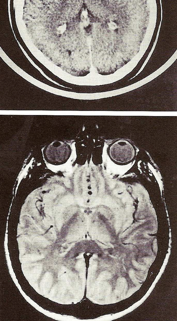 ventriculus lateralis A řez hemisférami těsně pod truncus corporis callosi, 9 corpus callosum zachycující striatum