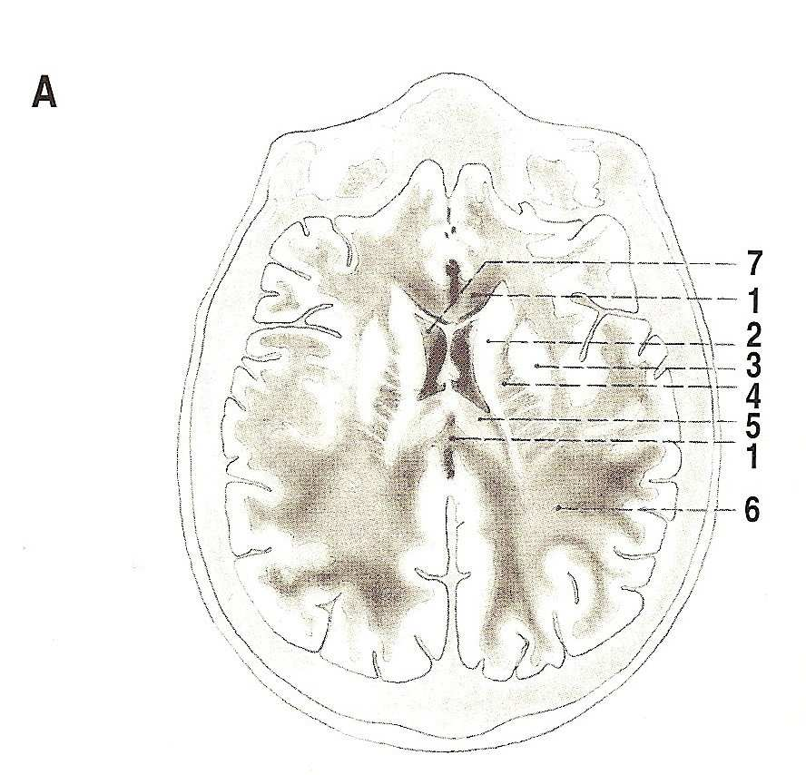 commissura putamen anterior (NMR) capsula interna putamen 5 thalamus globus pallidus 6 bílá hmota hemisféry capsula