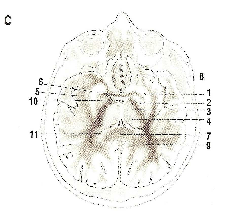 kaudálněji než řez A (CT) 6 commissura anterior caput nuclei caudati 7 corpus callosum capsula interna- crus anterius