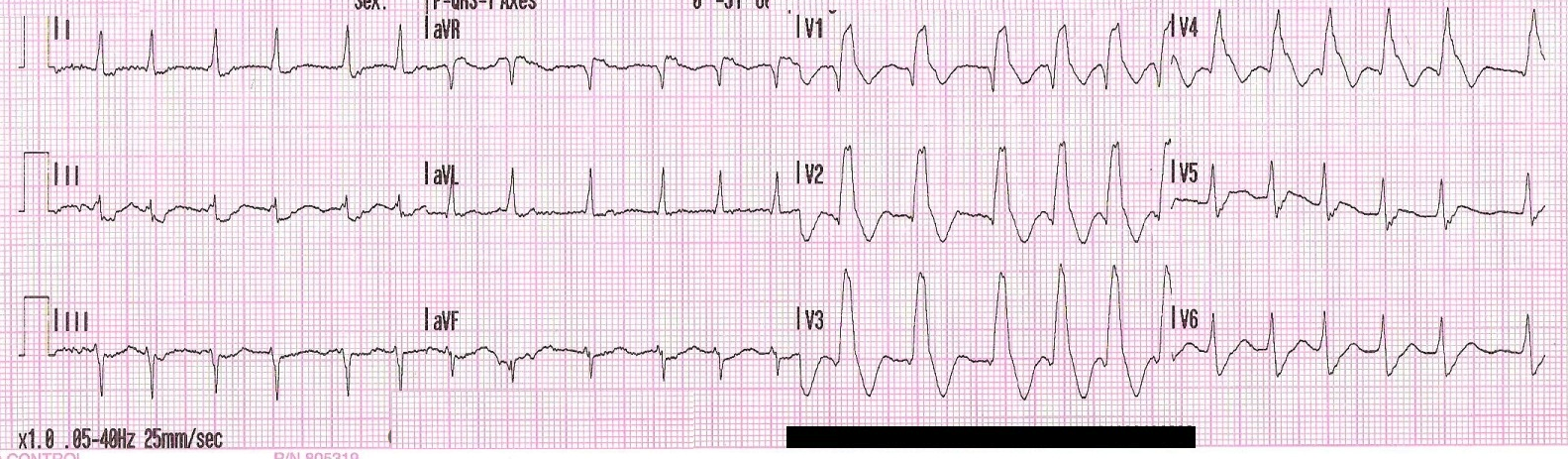 Elektronické srdce a plíce 24. Ochrnutí poloviny těla u nemocné s fibrilací síní (CMP) Paientka AČ, 78 let 1.