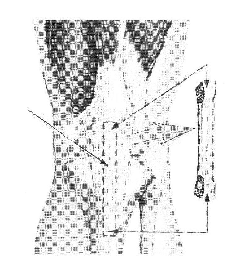 37 Obr. 6. Postup při odběru štěpu z lig. patellae (podle: Sosna, 2001) a tibiálním kostním kanálku. Přesné vyvrtání těchto kanálků je předpokladem k správné funkci vazu.