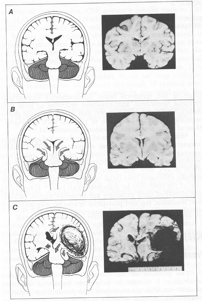 Herniace