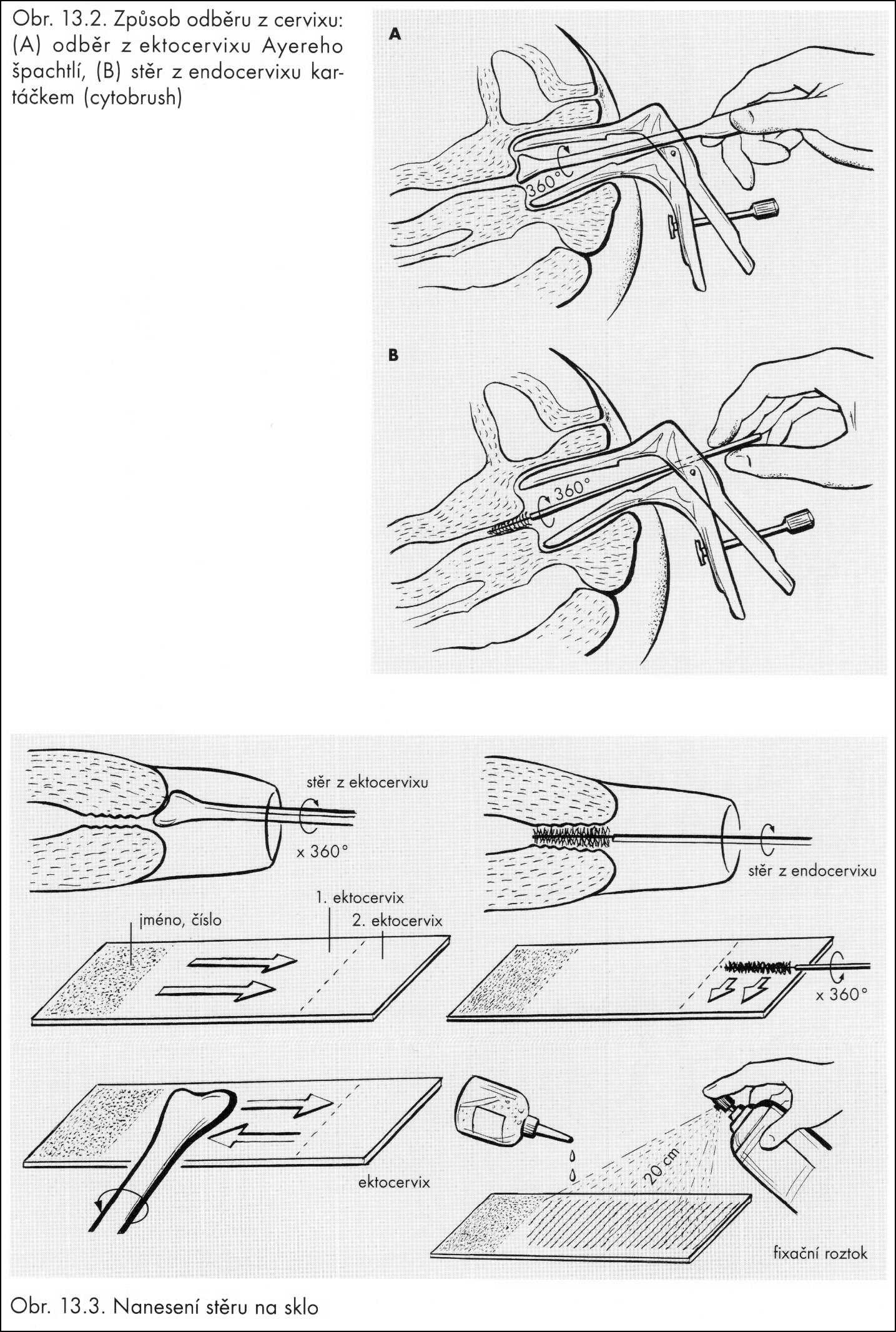Příloha 6: Způsob odběru a fixace cytologického materiálu Zdroj: (25) KOBILKOVÁ, Jitka