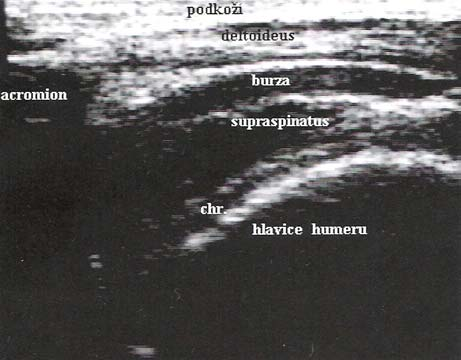 M. deltoideus U m. deltoideus posuzujeme obvykle traumatické a posttraumatické změny (hematomy, jizvy).