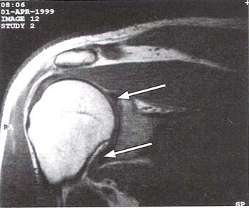 Labrum glenoidale Představuje fibrokartilaginózní strukturu, která zvětšuje plochu kloubní jamky lopatky a v součinnosti s glenohumerálními vazy ovlivňuje stabilitu kloubu.