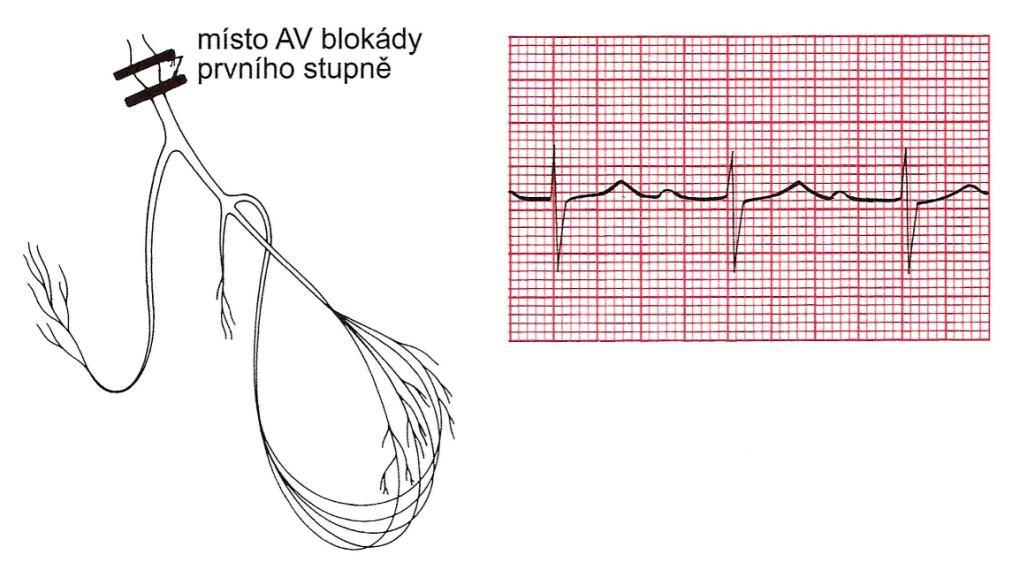 degenerativních změn převodního systému, objevuje se při myokarditidě, akutním infarktu myokardu, akutní revmatické horečce nebo v souvislosti s toxickým vlivem léků [1, 4, 6]. Obr.