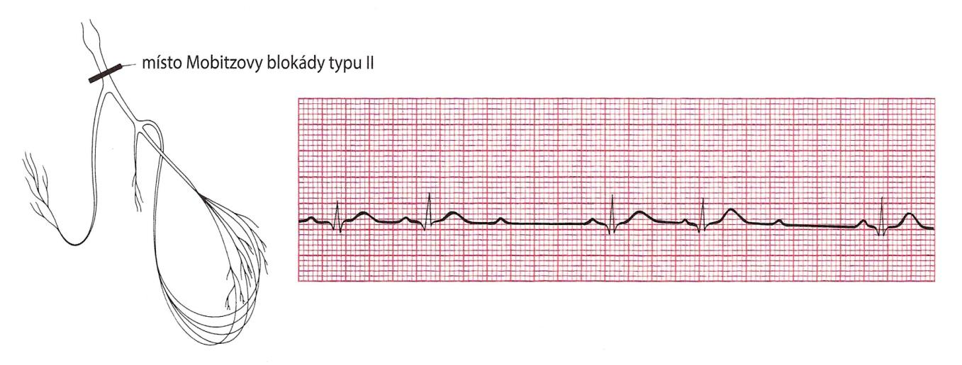 U této blokády není patrné postupné prodlužování PR intervalu, ale je charakterizována občasným neočekávaným výpadkem jednoho nebo více komplexů QRS, což je vidět na obr. 17.