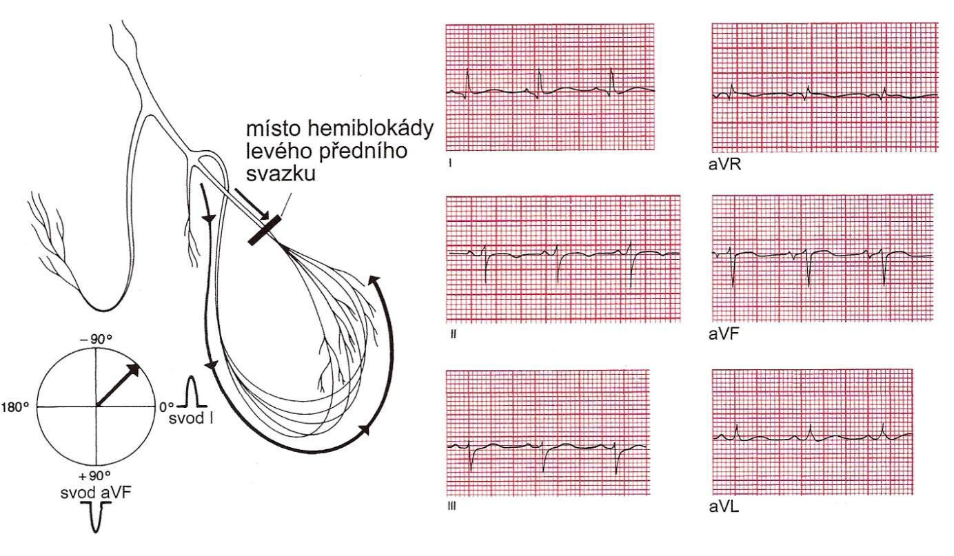 3.4 Hemiblokády Hemiblokády jsou izolované blokády předního, zadního nebo septálního svazku levého Tawarova raménka a v obrazu EKG se projevují hlavně ovlivněním sklonu srdeční osy.