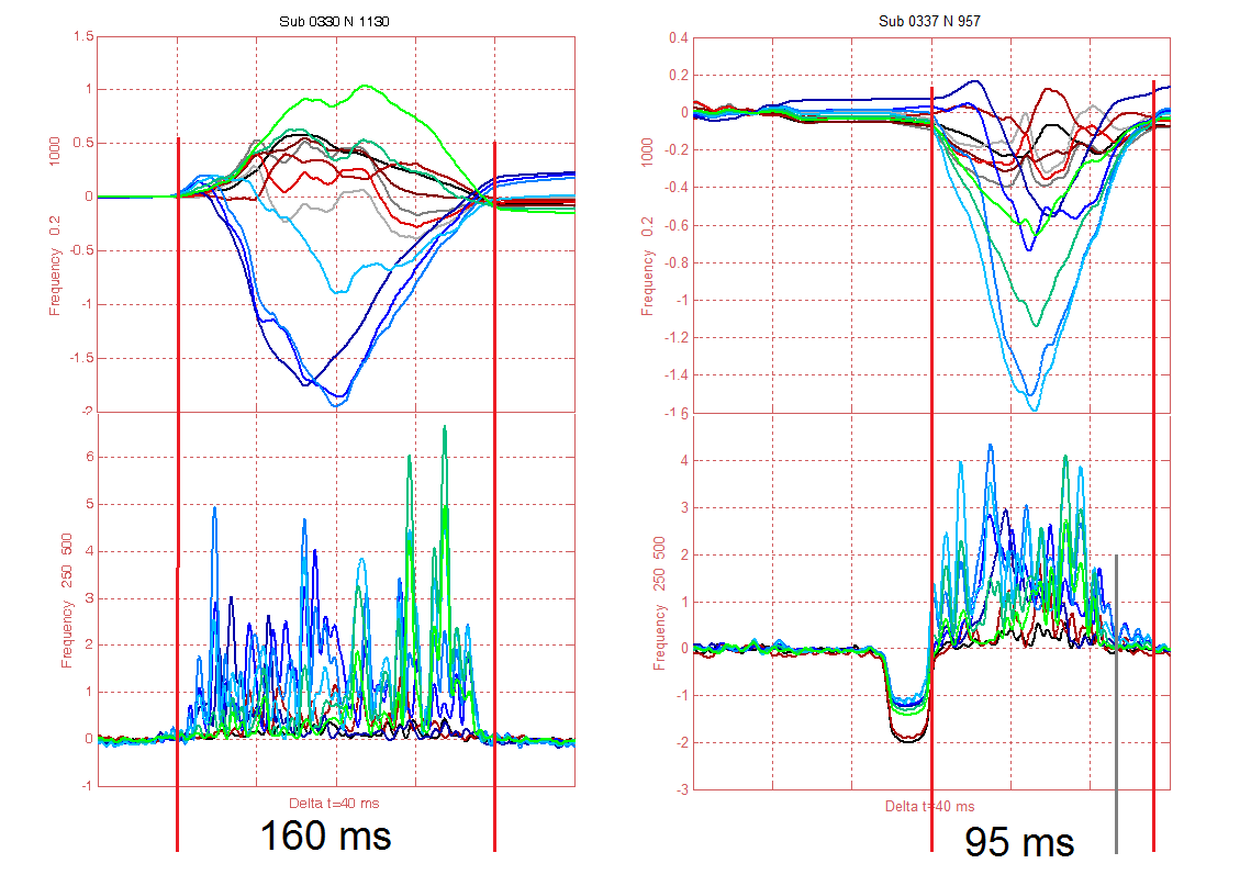 6.3 Výsledky resynchronizační terapie Při použití konvenčního EKG dosahuje resynchronizační terapie pozitivních výsledků asi u 2/3 pacientů.