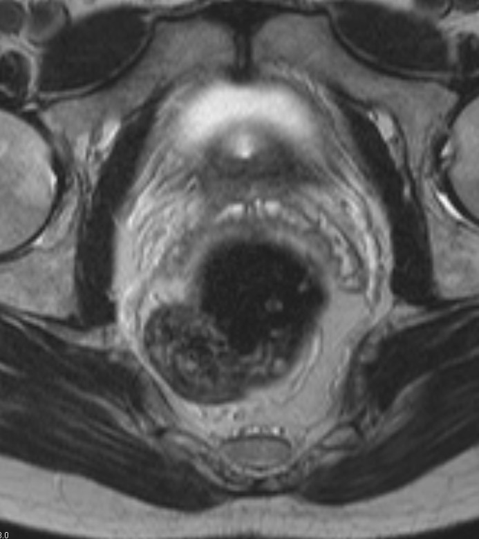 Rectum 15-20cm 1) Pars pelvina - nad diafragma pelvis 2) Canalis analis -