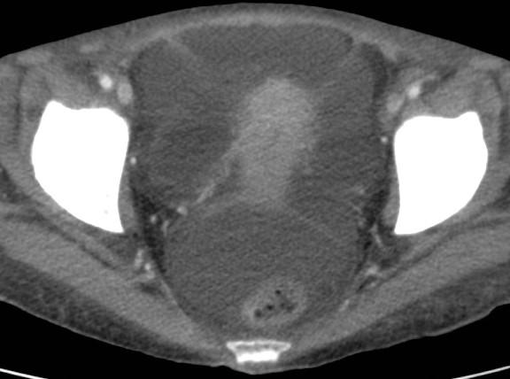 cardinale uteri cervix-malá pánev lig.