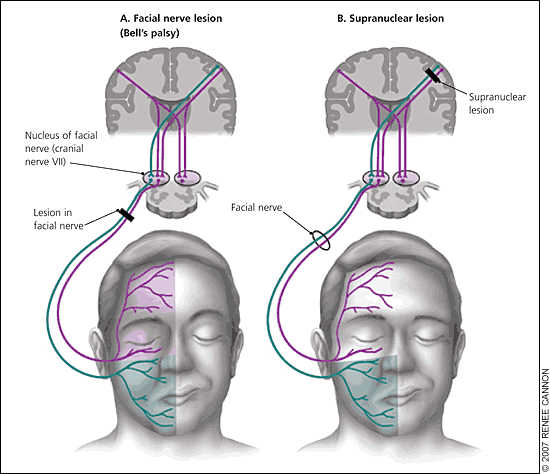 6 KLINICKÝ OBRAZ Klinický obraz u postiţení n. facialis se odvíjí od místa jeho postiţení. Rozlišujeme lézi periferní, centrální a nukleární. Obrázek 4.