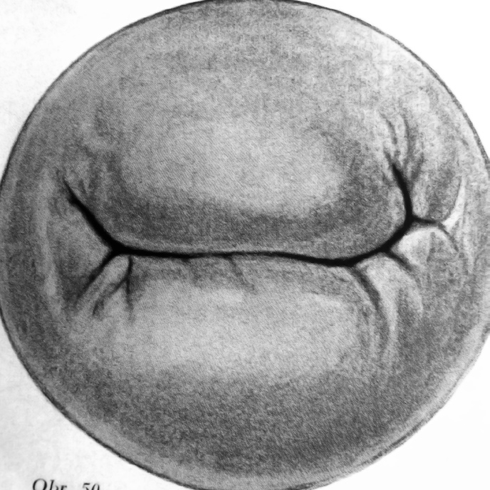 Obr. 7 Čípek multipary při 12násobném zvětšení. Zdroj: HINSELMANN, H. Verbesserung der Inspektionsmöglichkeiten von Vulva, Vagina und Portio. Münchener medizinische Wochenschrift, 1925, no. 10, p.